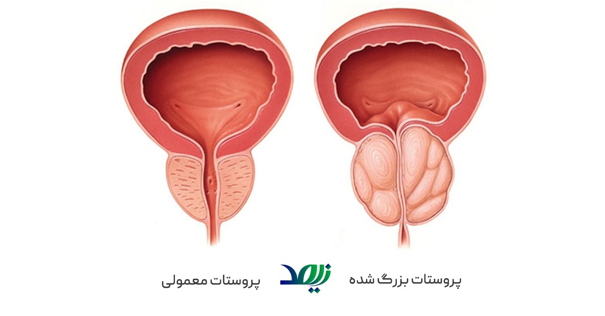 prostate-cancer-vs-enlarged